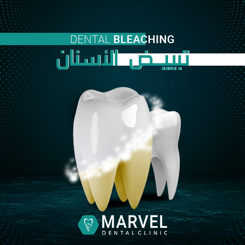 Dental Bleaching